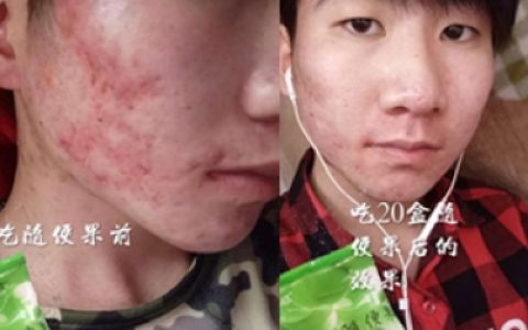 四季优美随便果祛痘、淡斑效果看得见