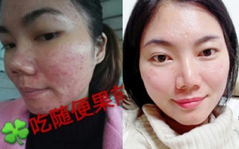 随便果+HHA面膜内调外用祛痘效果就是好