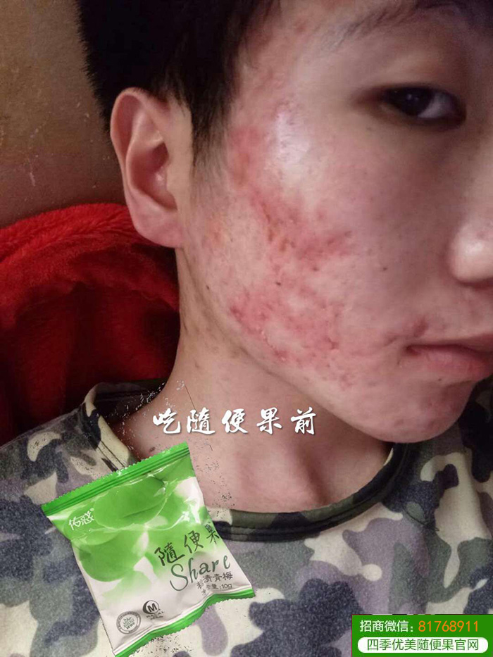 四季优美随便果祛痘、淡斑效果看得见