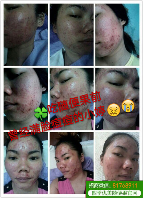 随便果+HHA面膜内调外用祛痘效果就是好