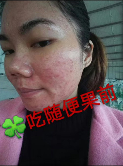 随便果+HHA面膜内调外用祛痘效果就是好