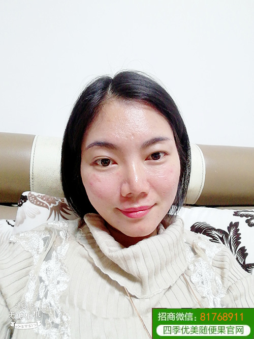 随便果+HHA面膜内调外用祛痘效果就是好