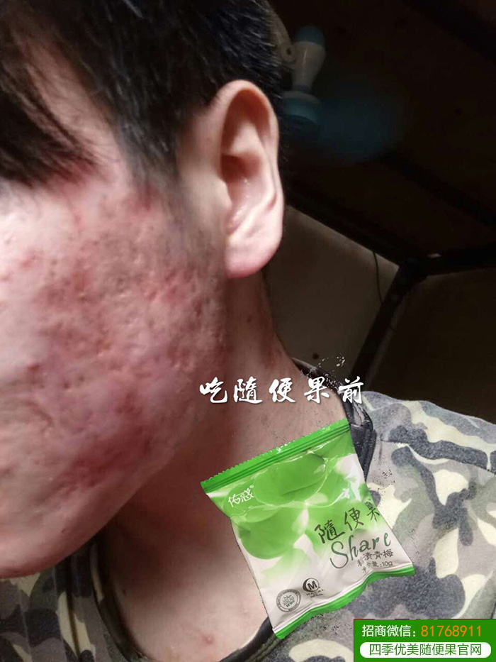 四季优美随便果祛痘、淡斑效果看得见